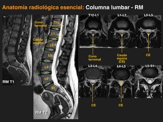 iDESIGN
by HiSlide.io
Anatomía radiológica esencial: Columna lumbar - RM
ativos
5
ciente femenino asintomático de 32 años a) T2W
scos intervertebrales b) T1W sagital: Hipointensidad
ción a hidratación adecuada.
b)
Paciente anterior. T2W axial: a) Nivel T12L1: Cono
el L3L4 e) Nivel L4L5 Observe la cauda equina libre
rviosos libres f) Nivel L5S1: Saco terminal.
d)L3L4 e)L4L5 f)L5S1
b)
I.III.1. Galería de imágenes por RM de cambios degenerativos
a) b)
a) b)
Cono
terminal
Cauda
equina
S1
L5
L4
L3
L2
L1
T12
RM T1
RM T2
Cono
terminal
Cauda
equina
(CE)
CE
CE
CE
T12-L1 L1-L2 L2-L3
L3-L4 L4-L5 L5-S1
 