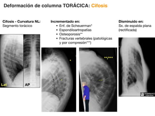 Deformación de columna TORÁCICA: Cifosis
Cifosis - Curvatura NL:
Segmento torácico
Incrementado en:
• Enf. de Scheuerman*
• Espondiloartropatías
• Osteoporosis**
• Fracturas vertebrales (patológicas
y por compresión***)
Disminuido en:
Sx. de espalda plana
(rectificada)
*
**/***
Lat AP
 