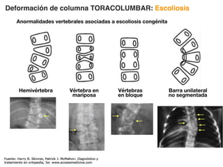 Deformación de columna TORACOLUMBAR: Escoliosis
Anormalidades vertebrales asociadas a escoliosis congénita
Hemivértebra Vértebra en
mariposa
Vértebras
en bloque
Barra unilateral
no segmentada
 