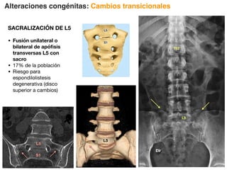 Alteraciones congénitas: Cambios transicionales
SACRALIZACIÓN DE L5
• Fusión unilateral o
bilateral de apófisis
transversas L5 con
sacro
• 17% de la población
• Riesgo para
espondilolistesis
degenerativa (disco
superior a cambios)
T12
L5
L5
S1
L5
 