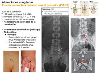 Alteraciones congénitas:
Fusión incompleta del arco neural posterior (FIANP)
30% de la población
En: Unión lumbosacra (L5  S1)
 cervical y torácica (C1  C7  T1)
• Usualmente hendidura pequeña
• No relacionada a defectos de la
neurulación
• Usualmente asintomática (hallazgo)
• Sintomática:
• ‘Hoyuelo’
• Dentro de la hendidura glútea
(HG): No requiere evaluación
• Por arriba de HG: Requieren
evaluación con RM o USG
(menores de 3 meses)
III
(Left) Anteroposterior
radiograph of the lumbosacral
spine (imaging performed for
low back pain) demonstrates
incidental incomplete fusion
of the S1 lamina . (Right)
Axial T1WI MR reveals typical
incomplete fusion of the
posterior elements in the
midline. This finding was
incidentally observed during
MR imaging for low back pain.
(Left) Coronal bone CT
demonstrates oblique
asymmetric rotation of the
L5 lamina with overlap,
a configuration thought to
produce rotational stresses
leading to premature facet
degenerative changes.
(Right) Axial bone CT at
the lumbosacral junction
in a patient with oblique
asymmetric rotation and
incomplete fusion of the
posterior elements additionally
demonstrates nondisplaced
L5 pars defects , possibly
related to rotational stress on
within posterior osseous defect
◦ Normal dural sac, conus position, and filum
thickness
• Lumbosacral junction (L5  S1)   cervical (C1  C7 
T1), thoracic
Top Differential Diagnoses
• Closed spinal dysraphism (CSD)
• Surgical laminectomy defect
• Normal progression of ossification
• Occasionally s
• Usually asymp
Diagnostic Ch
• Incomplete po
is very rarely o
• MR best for exc
abnormality, b
of cutaneous st
meninges médula
FIANP Meningocele Mielo-
meningocele
 