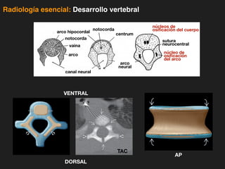 iDESIGN
by HiSlide.io
Radiología esencial: Desarrollo vertebral
APPROACH TO SPINE AND SPINAL CORD DEVELOPMENT
Spine:
Craniovertebral
Junction
(Left) Sagittal bone CT of
the sacrum and coccyx in a
24 month old demonstrates
normal ossification of the
5 sacral vertebra and first
3 coccygeal vertebra. The
underlying cartilaginous
model is faintly visible as soft
tissue density containing the
ossified centrums. (Right)
Coronal graphic shows
normal lumbar vertebral
body formation in a young
adolescent, with persistence
of the cartilaginous ring
apophysis following
ossification of the vertebral
body.
III
1
7
or hydromyelia is present.
(Left) Sagittal graphic (AAP
II sacrococcygeal teratoma)
shows a heterogeneous
necrotic neoplasm
located ventral to the sacrum.
Approximately equal external
and internal components
classify the tumor as AAP
type II. Absence of sacral
invasion is characteristic.
(Right) Sagittal T2WI MR
(AAP II sacrococcygeal
teratoma) depicts a mixed
cystic and solid pelvic mass.
The internal portion is
predominately solid, while
the external portion is
more cystic.
(Left) Axial graphic of the
thoracic spine in an infant
depicts the process of
ossification during normal
vertebral formation. The
vertebral and neural
arch primary ossification
centers are forming within
the cartilaginous vertebral
axis. (Right) Axial bone
CT in a 3-day-old infant
demonstrates normal CT
imaging appearance of
the vertebral centrum
and neural arch
primary ossification centers
separated by cartilaginous
synchondroses .
DORSAL
VENTRAL
AP
canal neural
arco
vaina
arco hipocordal
arco
neural
notocorda
centrum
núcleo de
osificación
del arco
núcleos de
osificación del cuerpo
sutura
neurocentral
notocorda
TAC
 