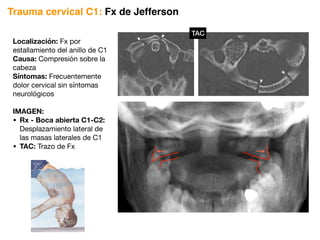 Trauma cervical C1: Fx de Jefferson
Localización: Fx por
estallamiento del anillo de C1
Causa: Compresión sobre la
cabeza
Síntomas: Frecuentemente
dolor cervical sin síntomas
neurológicos
IMAGEN:
• Rx - Boca abierta C1-C2:
Desplazamiento lateral de
las masas laterales de C1
• TAC: Trazo de Fx
HIGH-YIELD
FACTS
Musculoskeletal
Radiology of C1.
F I G U R E 6 - 9 . Jefferson fracture on plain radiograph (left) and CT (right).
HIGH-YIELD
FACTS
Musculoskeletal
Radiology of C1.
F I G U R E 6 - 9 . Jefferson fracture on plain radiograph (left) and CT (right).
TAC
 