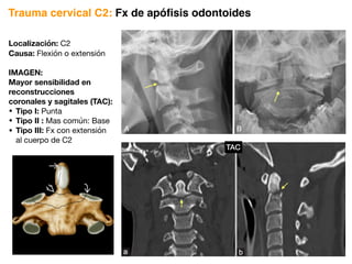 Localización: C2
Causa: Flexión o extensión
IMAGEN:
Mayor sensibilidad en
reconstrucciones
coronales y sagitales (TAC):
• Tipo I: Punta
• Tipo II : Mas común: Base
• Tipo III: Fx con extensión
al cuerpo de C2
Trauma cervical C2: Fx de apófisis odontoides
TAC
 