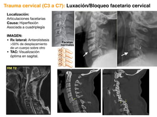Localización:
Articulaciones facetarias
Causa: Hiperflexión
Asociada a cuadriplegía
IMAGEN:
• Rx lateral: Anterolistesis
50% de desplazamiento
de un cuerpo sobre otro
• TAC: Visualización
óptima en sagital.
Trauma cervical (C3 a C7): Luxación/Bloqueo facetario cervical
C5
C4
Facetas
normales
RM T2
 