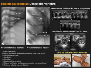 iDESIGN
by HiSlide.io
Radiología esencial: Desarrollo vertebral
2. Cuerpo vertebral
6. Discos epifisiarios anulares inferiores del cuerpo vertebral
10. Hendidura neonatal
11. Pedículo
13. Costillas
15. Espacios intersomático
18. Discos epifisiarios anulares superiores del cuerpo vertebral
19. Proceso articular superior (faceta)
Columna torácica neonatal Columna torácica 12 años
Ultrasonido de columna NEONATAL longitudinal
Ultrasonido de columna NEONATAL axial
USG de columna en 3 meses
 