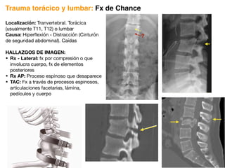 Localización: Tranvertebral. Torácica
(usualmente T11, T12) o lumbar
Causa: Hiperflexión - Distracción (Cinturón
de seguridad abdominal). Caídas
HALLAZGOS DE IMAGEN:
• Rx - Lateral: fx por compresión o que
involucra cuerpo, fx de elementos
posteriores
• Rx AP: Proceso espinoso que desaparece
• TAC: Fx a través de procesos espinosos,
articulaciones facetarias, lámina,
pedículos y cuerpo
Trauma torácico y lumbar: Fx de Chance
?
 