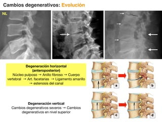 Cambios degenerativos: Evolución
Degeneración horizontal
(anteroposterior)
Núcleo pulposo → Anillo fibroso → Cuerpo
vertebral → Art. facetarias → Ligamento amarillo
→ estenosis del canal
Degeneración vertical
Cambios degenerativos severos → Cambios
degenerativos en nivel superior
I I
NL
 