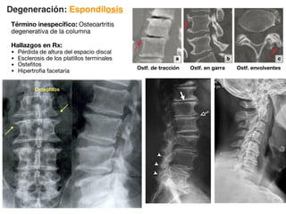 Degeneración: Espondilosis
Término inespecífico: Osteoartritis
degenerativa de la columna
Hallazgos en Rx:
• Pérdida de altura del espacio discal
• Esclerosis de los platillos terminales
• Ostefitos
• Hipertrofia facetaria
Osteofitos
Ostf. de tracción Ostf. en garra Ostf. envolventes
 
