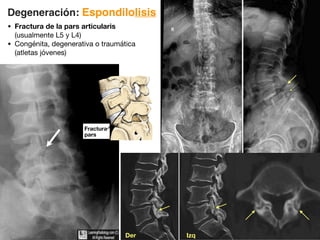• Fractura de la pars articularis
(usualmente L5 y L4)
• Congénita, degenerativa o traumática
(atletas jóvenes)
Degeneración: Espondilolisis
Fractura
pars
Der Izq
 