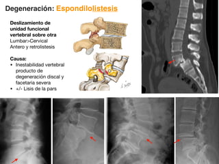 Degeneración: Espondilolistesis
Deslizamiento de
unidad funcional
vertebral sobre otra
LumbarCervical
Antero y retrolistesis
Causa:
• Inestabilidad vertebral
producto de
degeneración discal y
facetaria severa
• +/- Lisis de la pars
 