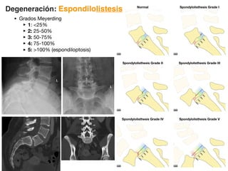 • Grados Meyerding
‣1: 25%
‣2: 25-50%
‣3: 50-75%
‣4: 75-100%
‣5: 100% (espondiloptosis)
Degeneración: Espondilolistesis
 