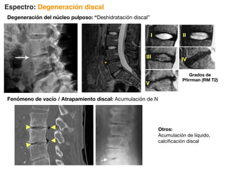 Espectro: Degeneración discal
Degeneración del núcleo pulposo: “Deshidratación discal”
Figura 8a, 8b. Degeneración discal. Paciente femenino de 35 años que refirió lumbalgia. a) T2W sagital: Degeneración
discal L4L5, observe hipointensidad comparativa (➤) b) T2W axial: Abombamiento difuso; los forámenes neuronales son
amplios.
➤
➤
➤
Figura 9a, 9b. Degeneración discal. Paciente femenino de 58 años que refirió lumbalgia y radiculopatía a) T1W
sagital: Degeneración discal L5S1, observe pérdida de altura y gas intradiscal, también conocido como fenómeno de
vacío (➤) y hernias intraóseas (nódulos de Schmorl) (Flecha) b) T2W sagital: Hiperintensidad símil a T1W en platillo
terminal inferior de L5 en relación a cambios Modic tipo II (➤).
➤
➤
a) b)
a) b)
Grados de
Pfirrman (RM T2)
I II
III
IV
V
Fenómeno de vacío / Atrapamiento discal: Acumulación de N
Otros:
Acumulación de líquido,
calcificación discal
 