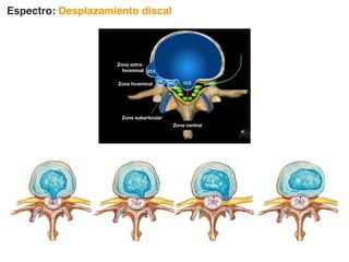 Zona central
Zona subarticular
Zona foraminal
Zona extra-
foraminal
Espectro: Desplazamiento discal
 