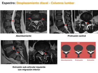 Extrusión sub-articular izquierda
con migración inferior
Espectro: Desplazamiento discal - Columna lumbar
La carga psicológica para un paciente con diagnóstico de enfermedad degenerativa lumbar ya ha sido estudiada
en relación a todos los factores involucrados, principalmente en cuanto a miedo de discapacidad y anticipación
de lesiones. Hemos notado la carga emocional que los pacientes presentan en espera de su interpretación de
RM y la importancia que esta significa, por lo que evitar el uso de términos con connotaciones culturales
negativas permite al médico que envía evaluar los hallazgos en relación la sintomatología para evitar
intervenciones innecesarias. Como ya mencionamos, los hallazgos degenerativos e incluso las hernias y
compresiones discales pueden para muchos pacientes ser asintomáticas sin embargo el paciente no logrará
comprender el hallazgo por RM y la ausencia de sintomatología 19, 20, 21, 22, 23.
El desplazamiento discal se refiere al proceso
de ocupación de espacio dentro del canal
espinal lumbar y representa uno de los
cambios en la enfermedad degenerativa de la
columna lumbar.
Los cambios degenerativos en relación a
desplazamiento/hernia discal son (Fig. 3) :
• Abombamiento
• Protrusión
• Extrusión
• Secuestro
I.II.3.1. Abombamiento discal
También conocido cómo “protrusión anular difusa” de acuerdo a la traducción Española, sin embargo debido a la
confusión que puede existir por incluir el término ‘protrusión’, utilizaremos el término “abombamiento” proveniente
de la nomenclatura original aceptada actualmente que en el idioma inglés corresponde a ‘bulging’ 24.
Figura 3. Desplazamiento discal / hernia discal.
a) Abombamiento, b) Protrusión, c)Extrusión.
➤
➤
➤
➤
≥90º
≥25%
➤
➤
Abombamiento Protrusión Extrusión
Abombamiento Protrusión central
 