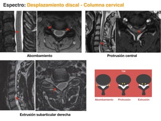 Protrusión central
La carga psicológica para un paciente con diagnóstico de enfermedad degenerativa lumbar ya ha sido estudiada
en relación a todos los factores involucrados, principalmente en cuanto a miedo de discapacidad y anticipación
de lesiones. Hemos notado la carga emocional que los pacientes presentan en espera de su interpretación de
RM y la importancia que esta significa, por lo que evitar el uso de términos con connotaciones culturales
negativas permite al médico que envía evaluar los hallazgos en relación la sintomatología para evitar
intervenciones innecesarias. Como ya mencionamos, los hallazgos degenerativos e incluso las hernias y
compresiones discales pueden para muchos pacientes ser asintomáticas sin embargo el paciente no logrará
comprender el hallazgo por RM y la ausencia de sintomatología 19, 20, 21, 22, 23.
El desplazamiento discal se refiere al proceso
de ocupación de espacio dentro del canal
espinal lumbar y representa uno de los
cambios en la enfermedad degenerativa de la
columna lumbar.
Los cambios degenerativos en relación a
desplazamiento/hernia discal son (Fig. 3) :
• Abombamiento
• Protrusión
• Extrusión
• Secuestro
I.II.3.1. Abombamiento discal
También conocido cómo “protrusión anular difusa” de acuerdo a la traducción Española, sin embargo debido a la
confusión que puede existir por incluir el término ‘protrusión’, utilizaremos el término “abombamiento” proveniente
de la nomenclatura original aceptada actualmente que en el idioma inglés corresponde a ‘bulging’ 24.
Figura 3. Desplazamiento discal / hernia discal.
a) Abombamiento, b) Protrusión, c)Extrusión.
➤
➤
➤
➤
≥90º
≥25%
➤
➤
Abombamiento Protrusión Extrusión
Espectro: Desplazamiento discal - Columna cervical
Abombamiento
Extrusión subarticular derecha
 