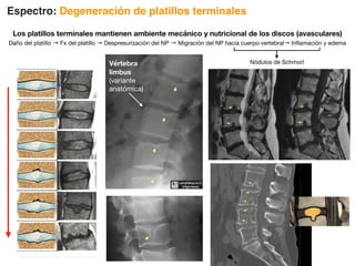 Espectro: Degeneración de platillos terminales
Los platillos terminales mantienen ambiente mecánico y nutricional de los discos (avasculares)
Daño del platillo → Fx del platillo → Despresurización del NP → Migración del NP hacia cuerpo vertebral→ Inflamación y edema
Nódulos de Schmorl
Vértebra
limbus
(variante
anatómica)
 