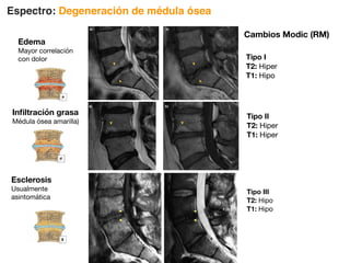 Espectro: Degeneración de médula ósea
Tipo I
T2: Hiper
T1: Hipo
Tipo II
T2: Hiper
T1: Hiper
Tipo III
T2: Hipo
T1: Hipo
7
Figura 11a, 11b. Cambios tipo Modic I. Paciente masculino de 40 años con lumbalgia crónica a) T2W sagital: Cambios en
platillos terminales de L5S1 con hiperintensidad (➤) en esta secuencia b) T1W sagital: Hipointensidad (➤) complementaria
a hiperintensidad en T2W; cambios sugestivos de edema.
➤
➤
➤
➤
➤ ➤
Figura 10a, 10b. Degeneración discal. Paciente femenino de 33 años con lumbalgia. a) T2W sagital: Degeneración discal
L4L5 grado 2 según Dominic (➤) b) T1W axial: Hipointensidad discal complementaria a T2 en L4L5 (➤).
a) b)
➤
➤
➤
➤
Figura 12a, 12b. Cambios Modic tipo II Paciente masculino de 38 años con lumbalgia y radiculopatía derecha a) T2W
sagital: Hiperintensidad de platillo terminal superior de disco intervertebral L4L5 (➤) b)T1W sagital: Hiperintensidad
complementaria (➤)
➤
➤
a) b)
a) b)
Cambios Modic (RM)
Edema
Mayor correlación
con dolor
Infiltración grasa
Médula ósea amarilla)
Esclerosis
Usualmente
asintomática
 