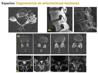 Espectro: Degeneración de articulaciones facetarias
NL
NL
NL
 