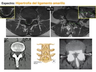 Espectro: Hipertrofia del ligamento amarillo
RM T1
 