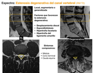 Espectro: Estenosis degenerativa del canal vertebral (RM T2)
Local, segmentaria o
generalizada
Factores que favorecen
la estenosis
degenerativa:
• Desplazamiento discal
• Espondilolistesis
• Hipertrofia facetaria
• Hipertrofia del
ligamento amarillo
Síntomas
compresivos:
• Médula
• Cono terminal
• Cauda equina
NL
Degenerativo
 