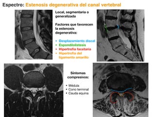 Espectro: Estenosis degenerativa del canal vertebral
Local, segmentaria o
generalizada
Factores que favorecen
la estenosis
degenerativa:
• Desplazamiento discal
• Espondilolistesis
• Hipertrofia facetaria
• Hipertrofia del
ligamento amarillo
Síntomas
compresivos:
• Médula
• Cono terminal
• Cauda equina
 