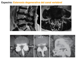 Espectro: Estenosis degenerativa del canal vertebral
 