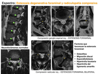 Figura 20a, 20b, 20c. Compresión radicular por estenosis foraminal. Paciente femenino de 57 años con lumbalgia y
radiculopatía bilateral de predominio izquierdo. a) T2W sagital: Compresión de raíz L3 (➤) por artrosis facetaria; compare forámenes
de segmentos adyacentes b) T2W axial: Ganglio espinal con compresión en neuroforámen (➤) c) T2W coronal: Compresión
radicular L3 (➤) y presencia de hemangiomas vertebrales hiperintensos.
➤
➤
➤
Figura 21a, 21b. Compresión radicular por protrusión posterolateral izquierda e hipertrofia facetaria. Paciente
➤
a) b) c)
a) b)
Figura 20a, 20b, 20c. Compresión radicular por estenosis foraminal. Paciente femenino de 57 años con lumbalgia y
radiculopatía bilateral de predominio izquierdo. a) T2W sagital: Compresión de raíz L3 (➤) por artrosis facetaria; compare forámenes
de segmentos adyacentes b) T2W axial: Ganglio espinal con compresión en neuroforámen (➤) c) T2W coronal: Compresión
radicular L3 (➤) y presencia de hemangiomas vertebrales hiperintensos.
➤
➤
➤
Figura 21a, 21b. Compresión radicular por protrusión posterolateral izquierda e hipertrofia facetaria. Paciente
masculino de 69 años con lumbalgia y radiculopatía izquierda. a) T2W sagital: Protrusión posterolateral y foraminal izquierda
a nivel L5S1, hipertrofia facetaria de predominio izquierdo. b) T2W sagital: Compresión radicular de L5 (➤), compare
➤
a) b) c)
a) b)
Compresión ganglio espinal izq. - ESTENOSIS FORAMINAL
Compresión radicular izq. - ESTENOSIS FORAMINAL BILATERAL
Neuroforámenes normales
12
e hipertrofia facetaria. Paciente
n posterolateral y foraminal izquierda
sión radicular de L5 (➤), compare
con neuroforámenes de paciente
angioma vertebral.
Espectro: Estenosis degenerativa foraminal y radiculopatía compresiva
Factores que
favorecen la estenosis
foraminal:
• Osteofitos
• Migración discal
• Espondilolistesis
• Hipertrofia facetaria
• Hipertrofia del
ligamento amarillo
 