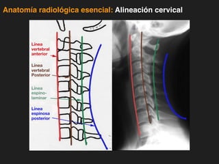 iDESIGN
by HiSlide.io
Anatomía radiológica esencial: Alineación cervical
Línea
vertebral
anterior
Línea
vertebral
Posterior
Línea
espino-
laminar
Línea
espinosa
posterior
 