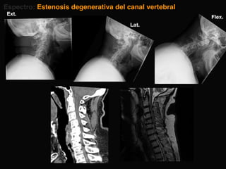 Espectro: Estenosis degenerativa del canal vertebral
Lat.
Flex.
Ext.
 