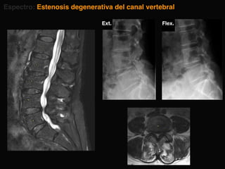 Espectro: Estenosis degenerativa del canal vertebral
Flex.
Ext.
 