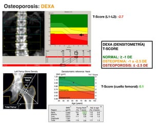 DEXA (DENSITOMETRÍA)
T-SCORE
NORMAL: ≥ -1 DE
OSTEOPENIA: -1 a -2.5 DE
OSTEOPOROSIS: ≤ -2.5 DE
Osteoporosis: DEXA
T-Score (L1-L2): -2.7
T-Score (cuello femoral): 0.1
 