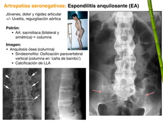 Jóvenes, dolor y rigidez articular
+/- Uveitis, regurgitación aórtica
Patrón:
• Art. sacroiliaca (bilateral y
simétrica)→ columna
Imagen:
• Anquilosis ósea (columna)
• Sindesmofito: Osificación paravertebral
vertical (columna en ‘caña de bambú’)
• Calcificación de LLA
Artropatías seronegativas: Espondilitis anquilosante (EA)
 