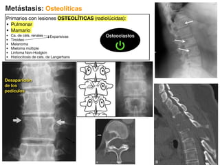 Metástasis: Osteolíticas
Primarios con lesiones OSTEOLÍTICAS (radiolúcidas):
• Pulmonar
• Mamario
• Ca. de céls. renales
• Tiroideo
• Melanoma
• Mieloma múltiple
• Linfoma Non-Hodgkin
• Histiocitosis de cels. de Langerhans
Desaparición
de los
pedículos
Osteoclastos
Expansivas
 