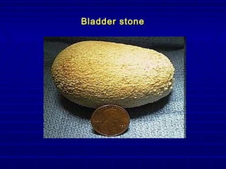 Urinary Stones Disease - Urolithiasis | PPT