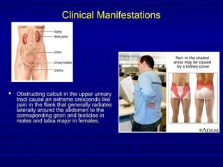 Urinary Stones Disease - Urolithiasis | PPT