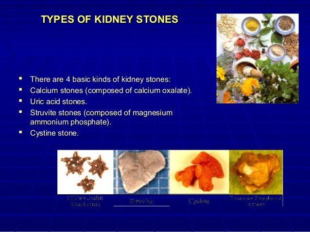 urinary stones disease urinary stones