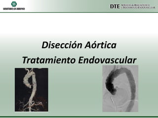 Disección Aórtica
Tratamiento Endovascular

 