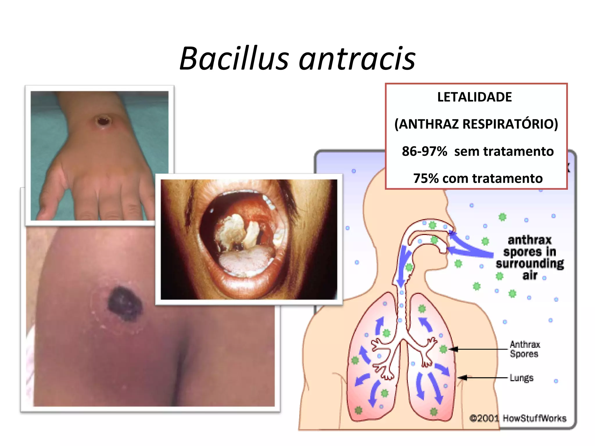 Bacillus antracis
LETALIDADE
(ANTHRAZ RESPIRATÓRIO)
86-97% sem tratamento
75% com tratamento
 