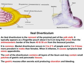 Ileal Diverticulum
An ileal diverticulum is the remnant of the proximal part of the yolk stalk. It
typically appears as a fingerlike pouch about 3 to 6 cm long that arises from the
antimesenteric border of the ileum 40 t0 50 cm from the ileocecal junction.
It is common. Meckel diverticulum occurs in 2 to 4 % of people and is 3 to 5 times
more prevalent in males than females. When it inflames, it causes symptoms that
mimic appendicitis.
The wall of the diverticulum contains all layers of the ileum and may contain small
patches of gastric and pancreatic tissues.
The gastric mucosa often secrets acid producing ulceration and bleeding.
 