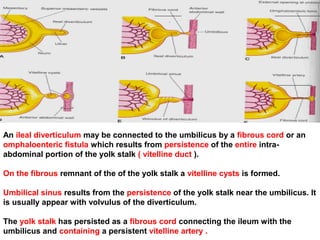 An ileal diverticulum may be connected to the umbilicus by a fibrous cord or an
omphaloenteric fistula which results from persistence of the entire intra-
abdominal portion of the yolk stalk ( vitelline duct ).
On the fibrous remnant of the of the yolk stalk a vitelline cysts is formed.
Umbilical sinus results from the persistence of the yolk stalk near the umbilicus. It
is usually appear with volvulus of the diverticulum.
The yolk stalk has persisted as a fibrous cord connecting the ileum with the
umbilicus and containing a persistent vitelline artery .
 