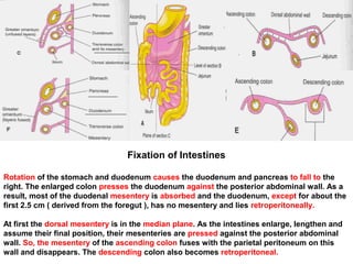Fixation of Intestines
Rotation of the stomach and duodenum causes the duodenum and pancreas to fall to the
right. The enlarged colon presses the duodenum against the posterior abdominal wall. As a
result, most of the duodenal mesentery is absorbed and the duodenum, except for about the
first 2.5 cm ( derived from the foregut ), has no mesentery and lies retroperitoneally.
At first the dorsal mesentery is in the median plane. As the intestines enlarge, lengthen and
assume their final position, their mesenteries are pressed against the posterior abdominal
wall. So, the mesentery of the ascending colon fuses with the parietal peritoneum on this
wall and disappears. The descending colon also becomes retroperitoneal.
 