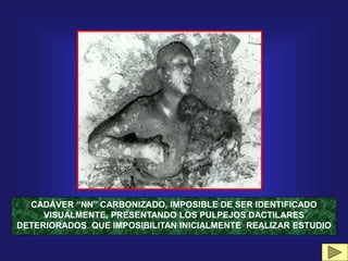CADÁVER “NN” CARBONIZADO, IMPOSIBLE DE SER IDENTIFICADO
VISUALMENTE, PRESENTANDO LOS PULPEJOS DACTILARES
DETERIORADOS QUE IMPOSIBILITAN INICIALMENTE REALIZAR ESTUDIO
 