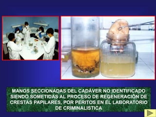 MANOS SECCIONADAS DEL CADÁVER NO IDENTIFICADO
SIENDO SOMETIDAS AL PROCESO DE REGENERACIÓN DE
CRESTAS PAPILARES, POR PERITOS EN EL LABORATORIO
DE CRIMINALISTICA
 