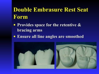 Double Embrasure Rest SeatDouble Embrasure Rest Seat
FormForm
• Provides space for the retentive &Provides space for the retentive &
bracing armsbracing arms
• Ensure all line angles are smoothedEnsure all line angles are smoothed
 
