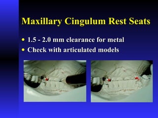Maxillary Cingulum Rest SeatsMaxillary Cingulum Rest Seats
• 1.5 - 2.0 mm clearance for metal1.5 - 2.0 mm clearance for metal
• Check with articulated modelsCheck with articulated models
 