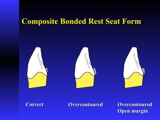 Composite Bonded Rest Seat FormComposite Bonded Rest Seat Form
CorrectCorrect OvercontouredOvercontoured OvercontouredOvercontoured
Open marginOpen margin
 