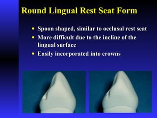Round Lingual Rest Seat FormRound Lingual Rest Seat Form
• Spoon shaped, similar to occlusal rest seatSpoon shaped, similar to occlusal rest seat
• More difficult due to the incline of theMore difficult due to the incline of the
lingual surfacelingual surface
• Easily incorporated into crownsEasily incorporated into crowns
 