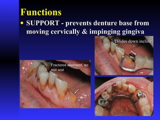 FunctionsFunctions
• SUPPORT - prevents denture base fromSUPPORT - prevents denture base from
moving cervically & impinging gingivamoving cervically & impinging gingiva
Slides down inclineSlides down incline
Fractured abutment, no
rest seat
 