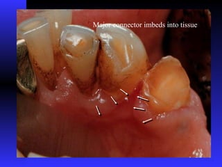Major connector imbeds into tissue
 